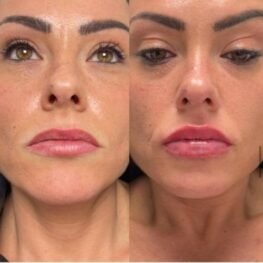 best-lip-filler-surrey