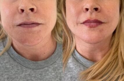 lip-filler-worcester-park
