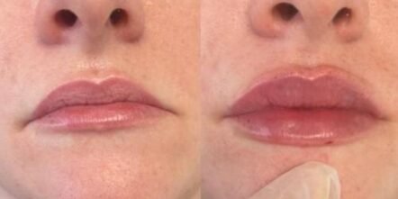 lip-filler-surrey