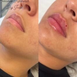 lip-enhancement-surrey