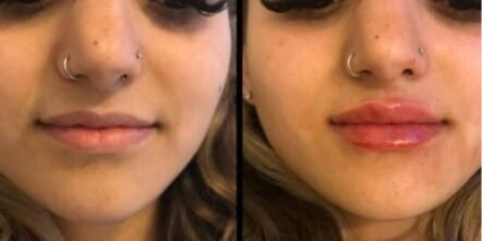 best-lip-filler-worcester-park