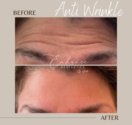 forehead-botox-worcester-park-surrey
