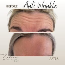 anti-wrinkle-injections-surrey